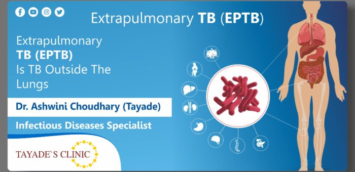 Extrapulmonary tuberculosis (EPTB)