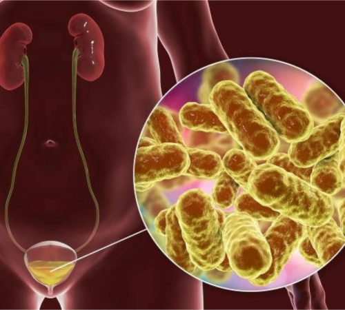 Complicated or recurrent Urinary Infection By Dr Ashwini Tayade