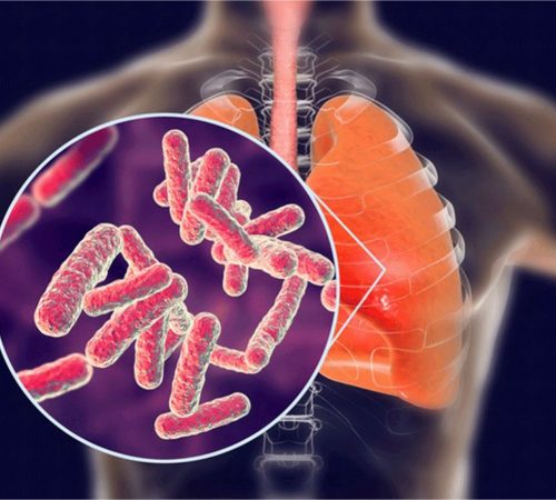 TB-Tuberculosis Treatment By Dr Ashwini Tayade